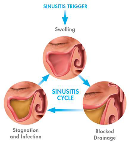 Sinusitis